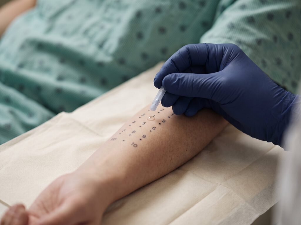 Skin prick allergy test on a forearm